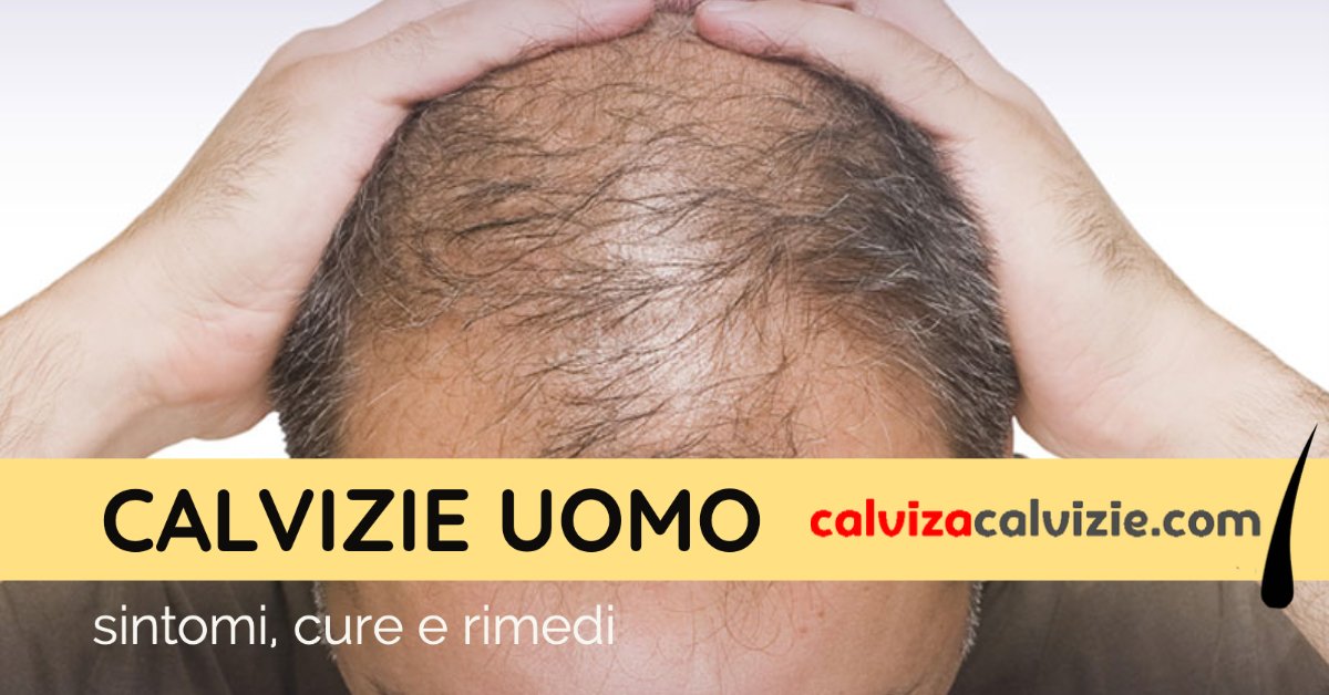 Calvizie Uomo Calviziacalvizie Com