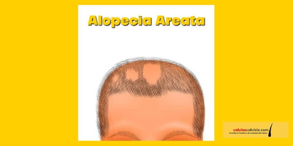 Come si guarisce da alopecia areata