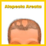 Come si guarisce da alopecia areata