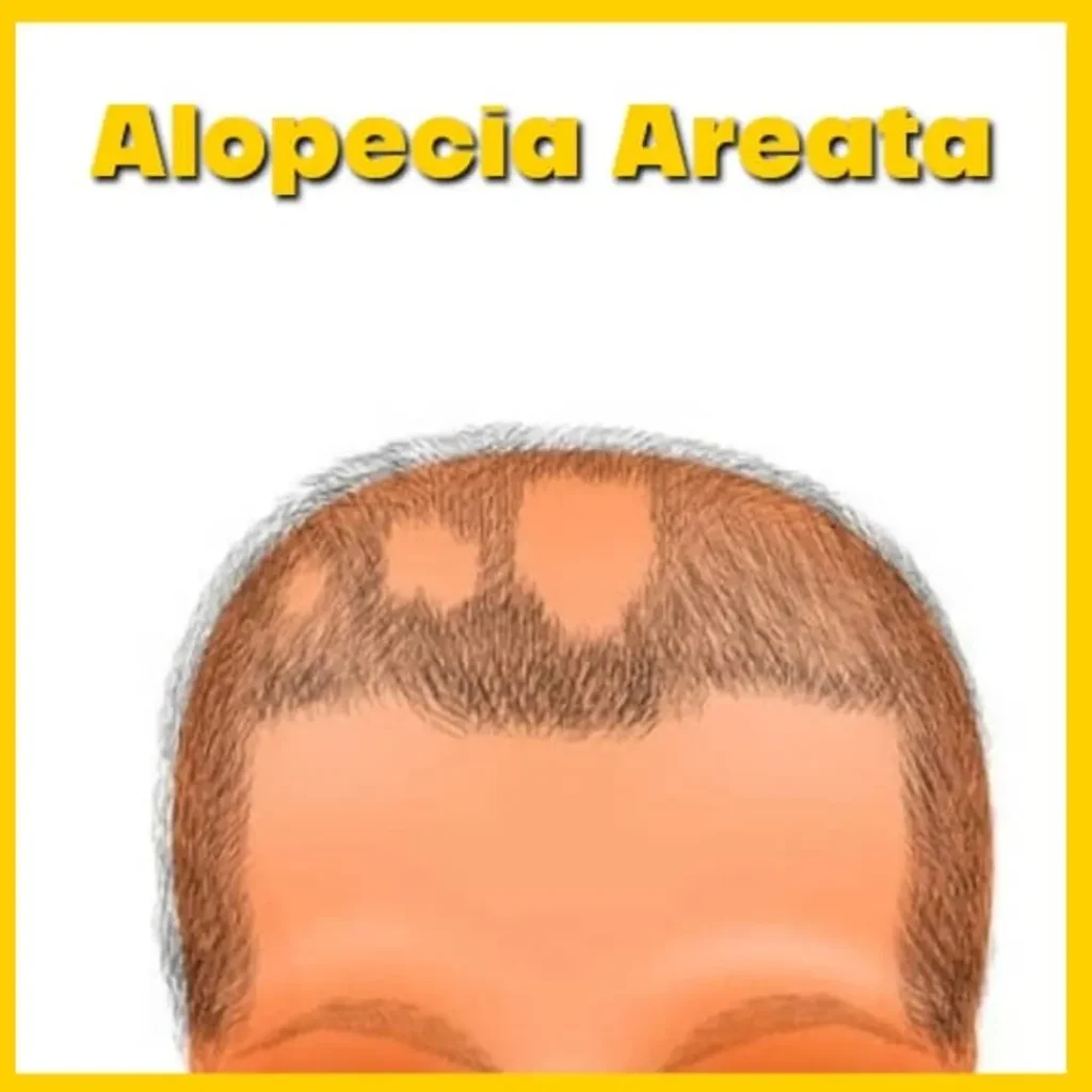 Alopecia areata cura